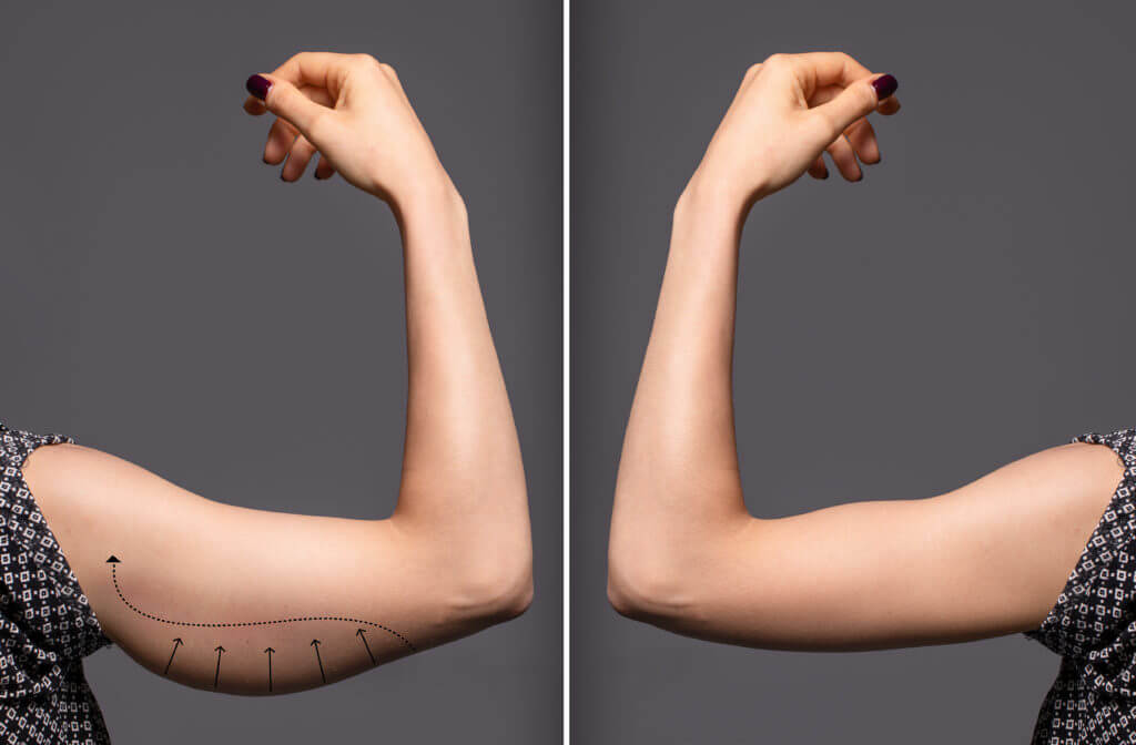 What kind of Cosmetic Procedures Can I get Done for My Arms
